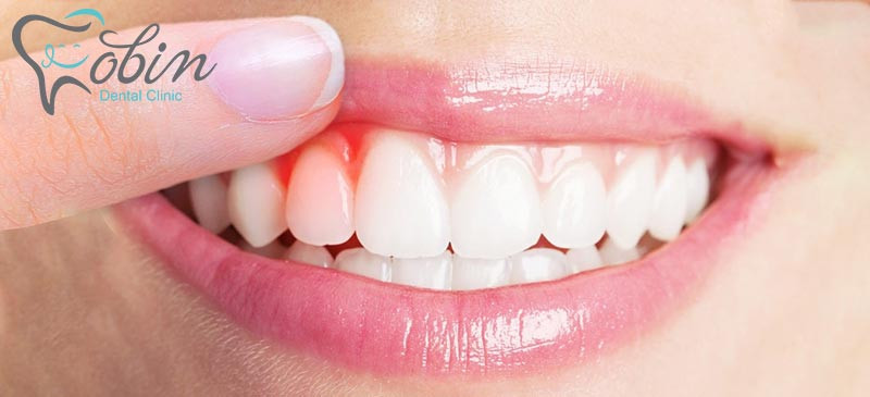 بروز حساسیت لثه در اثر کامپوزیت دندان